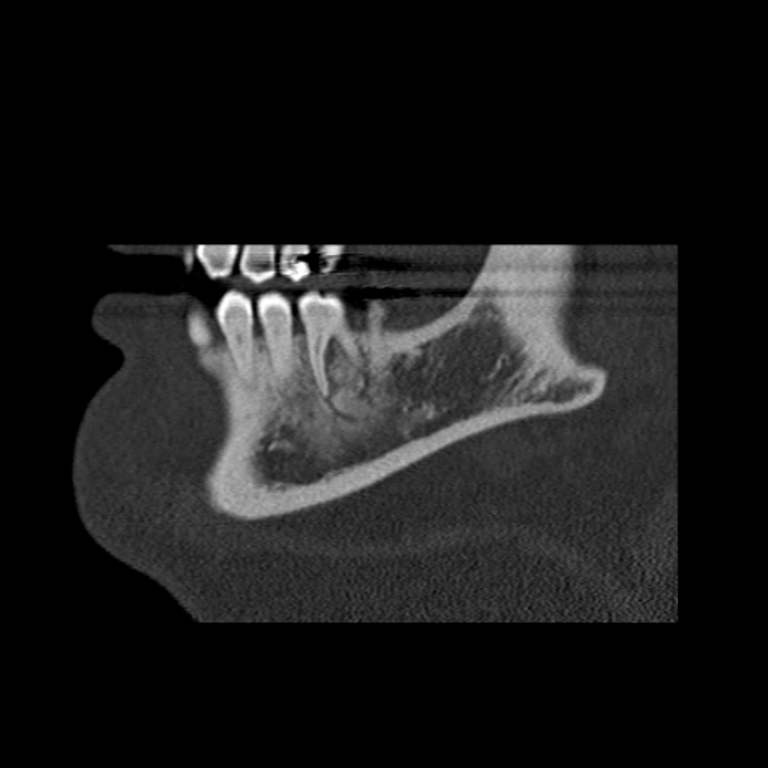 Figure 5 for case Chondroblastic osteosarcoma of the mandible